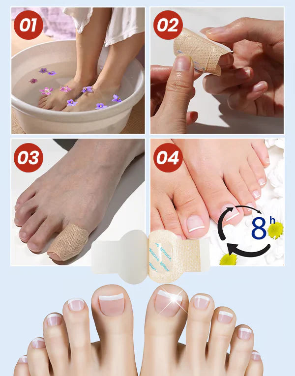 ClearNail™ seenevastased plaastrid küüntele