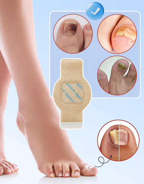 ClearNail™ seenevastased plaastrid küüntele