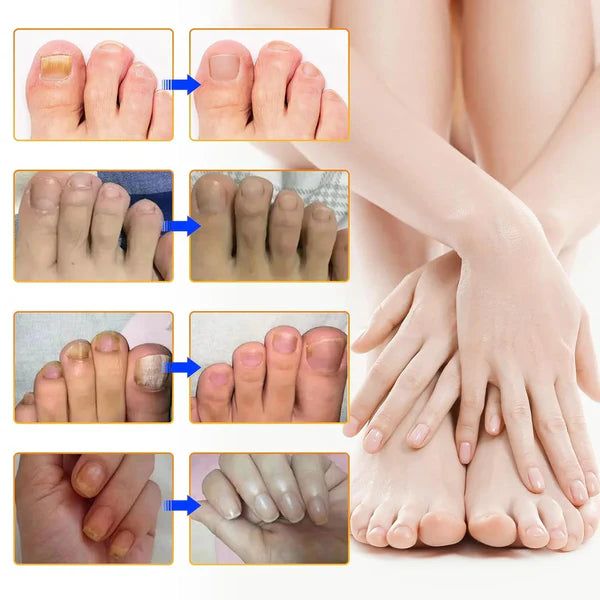 ClearNail™ seenevastased plaastrid küüntele