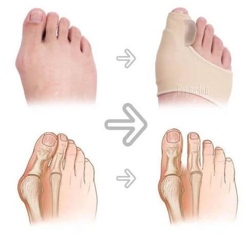 FixedFeet™ jalalahas